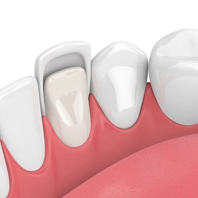 Veneers