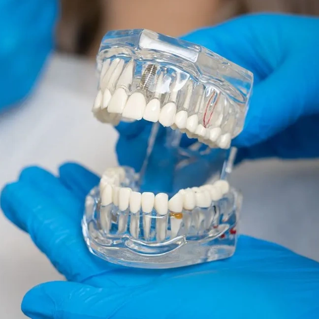 Single Implants