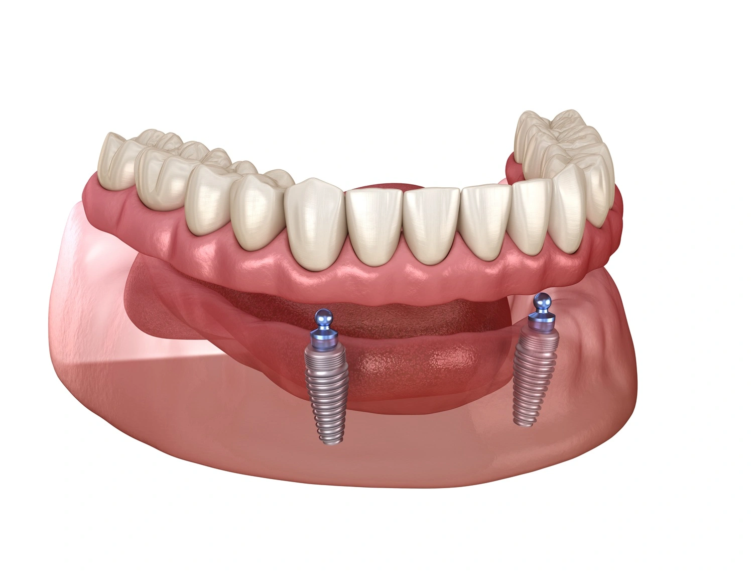 Locate Dentures