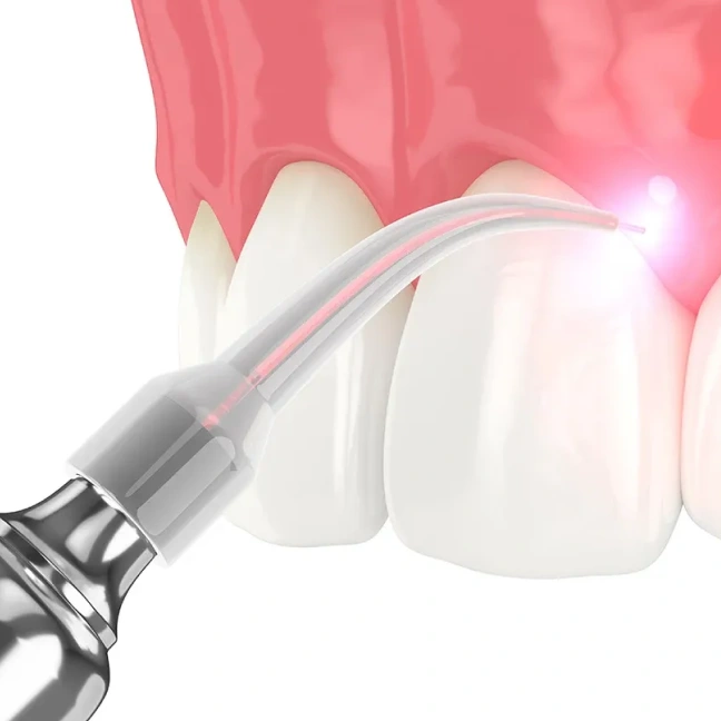 Soft-Tissue Laser Therapy