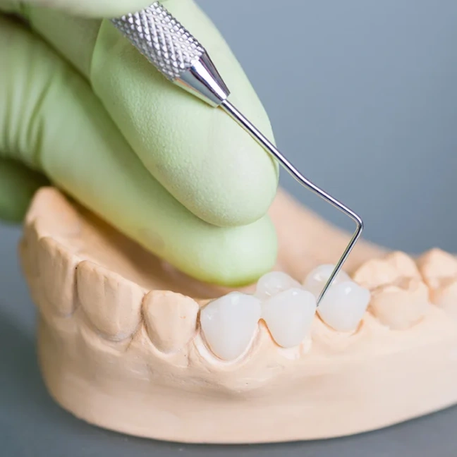 Dental Bridges