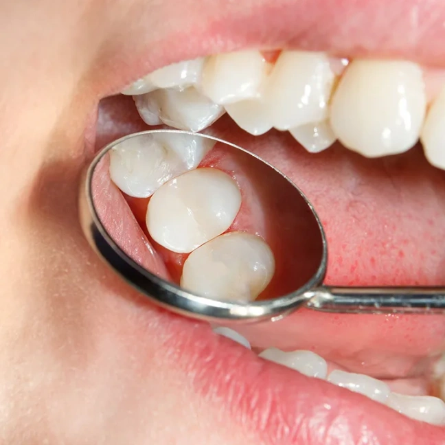 Tooth-colored filling to restore a damaged tooth