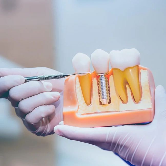 Dental Implants