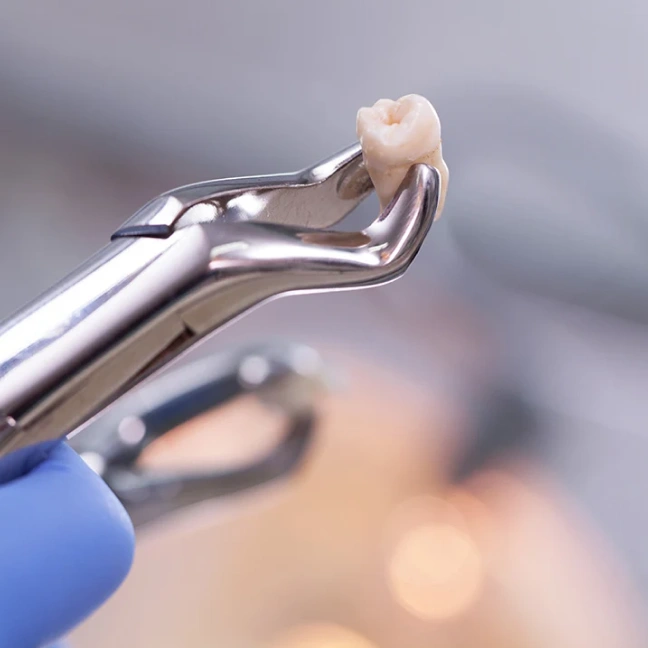 Gentle tooth extraction performed by a dental professional