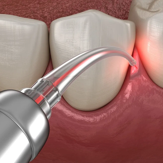Advanced laser dental treatment for precise and comfortable care