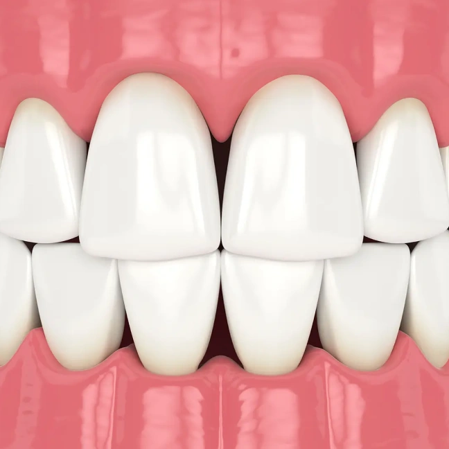 Minimally invasive cosmetic dental treatment for natural-looking teeth