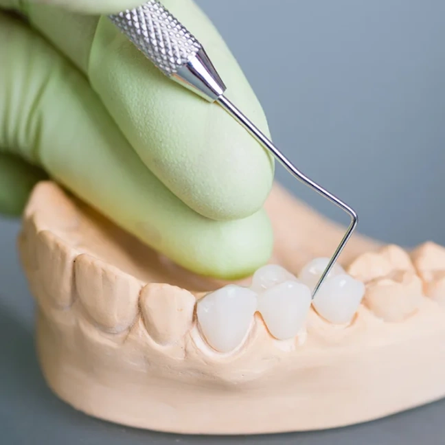 Custom dental bridge designed to restore missing teeth