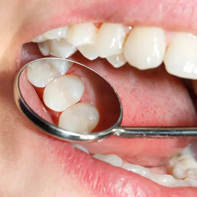 Dentist examining a tooth for cavity treatment