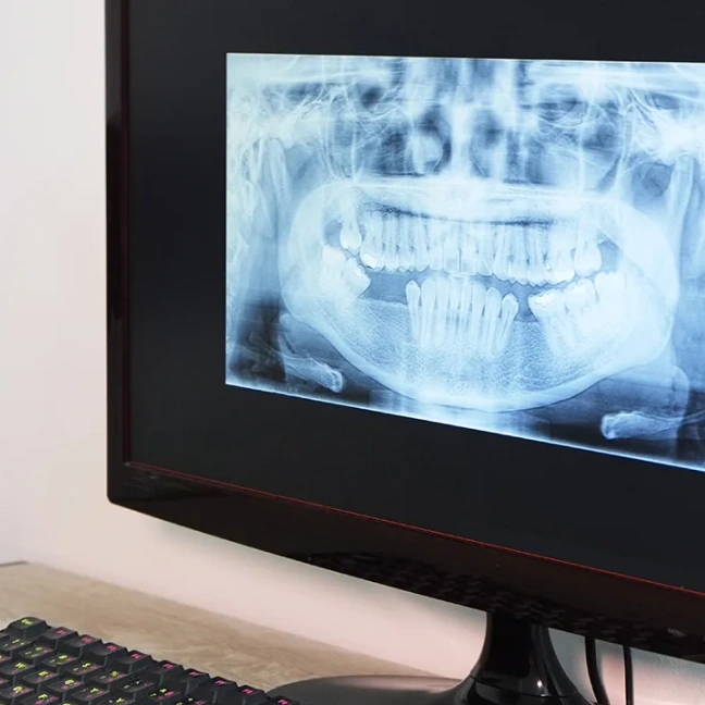 Digital dental X-ray used for accurate diagnosis and treatment planning