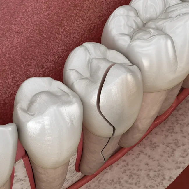 Damaged tooth requiring immediate dental attention