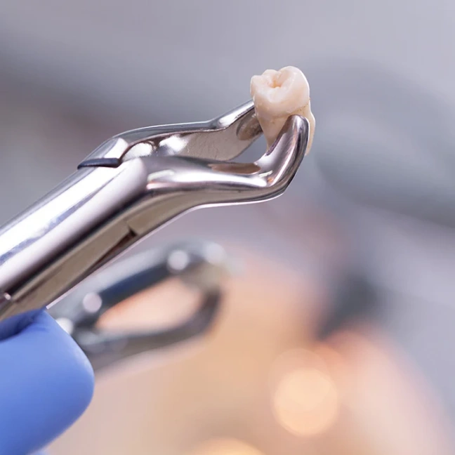 Dental extraction procedure performed with professional care