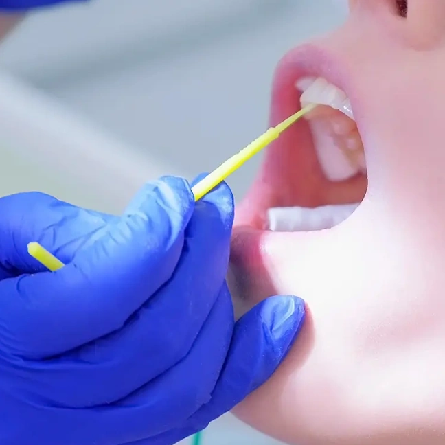 Professional fluoride treatment to strengthen tooth enamel