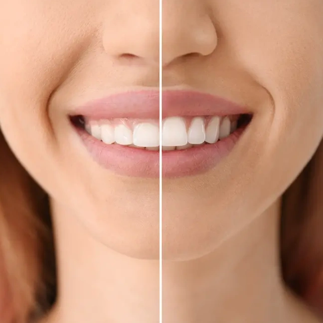 Cosmetic gum contouring for a balanced smile