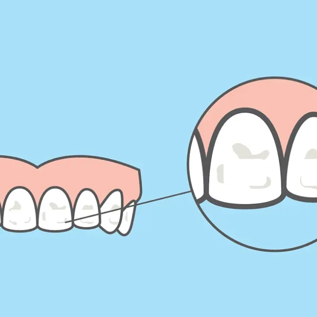 Illustration showing treatment for white spot lesions on teeth