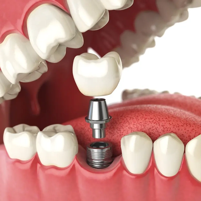 Dental implant fixture placed in the jawbone to replace a missing tooth.