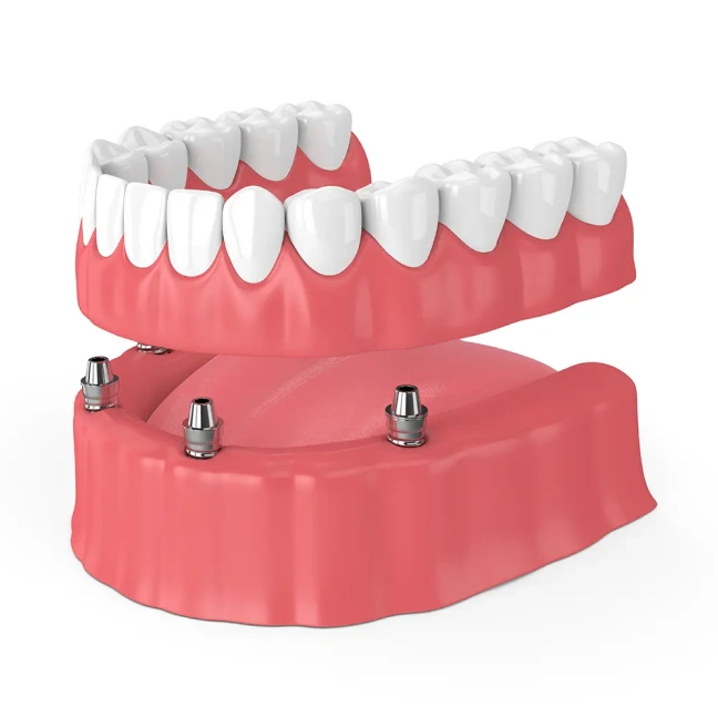 Implant-retained dentures model showing secure tooth replacement