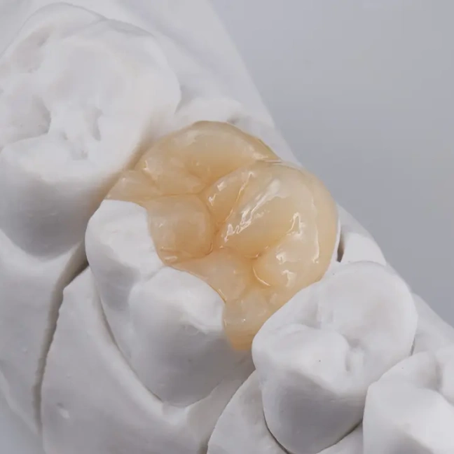 Ceramic dental inlay placed on a tooth