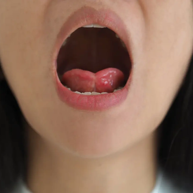 Open mouth showing tongue before frenectomy procedure