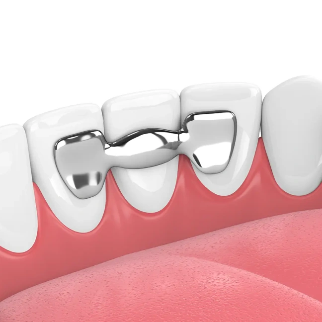 Maryland dental bridge replacing a missing tooth