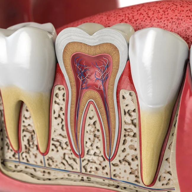 Cross-section illustration of root canal treatment