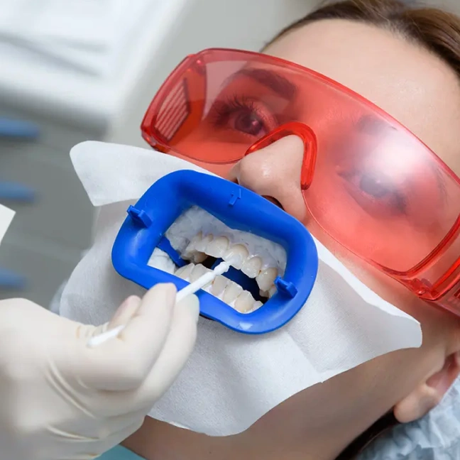 Professional teeth whitening with cheek retractors