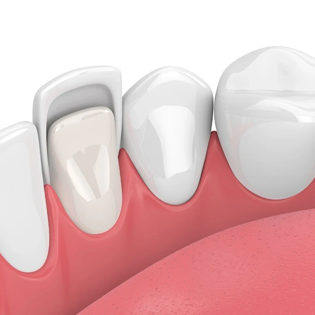 Illustration showing porcelain veneers on front teeth